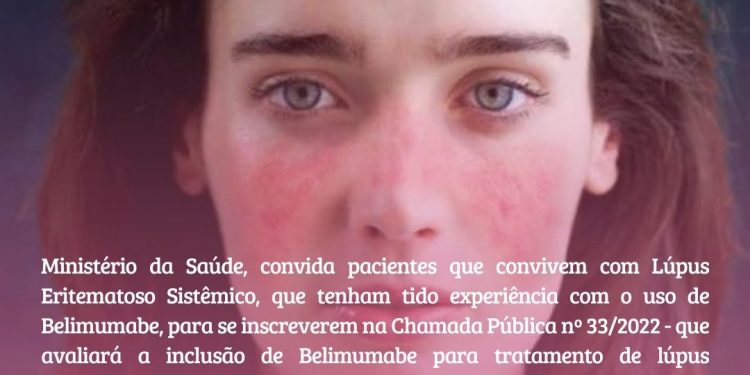 Conitec inscreve pacientes com lúpus e experiência com Belimumabe para contribuir com a perspectiva do paciente