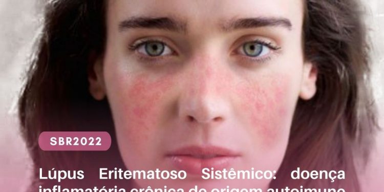 Lúpus Eritematoso Sistêmico: doença inflamatória crônica de origem autoimune atinge principalmente as mulheres de diversas idades