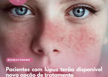 Pacientes com lúpus terão disponível nova opção de tratamento