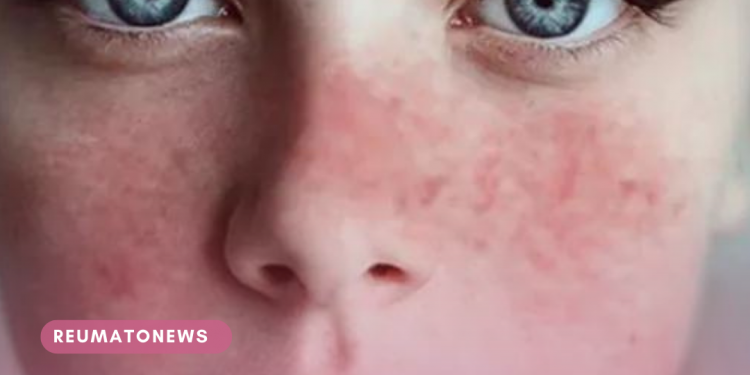 Pacientes com lúpus terão disponível nova opção de tratamento