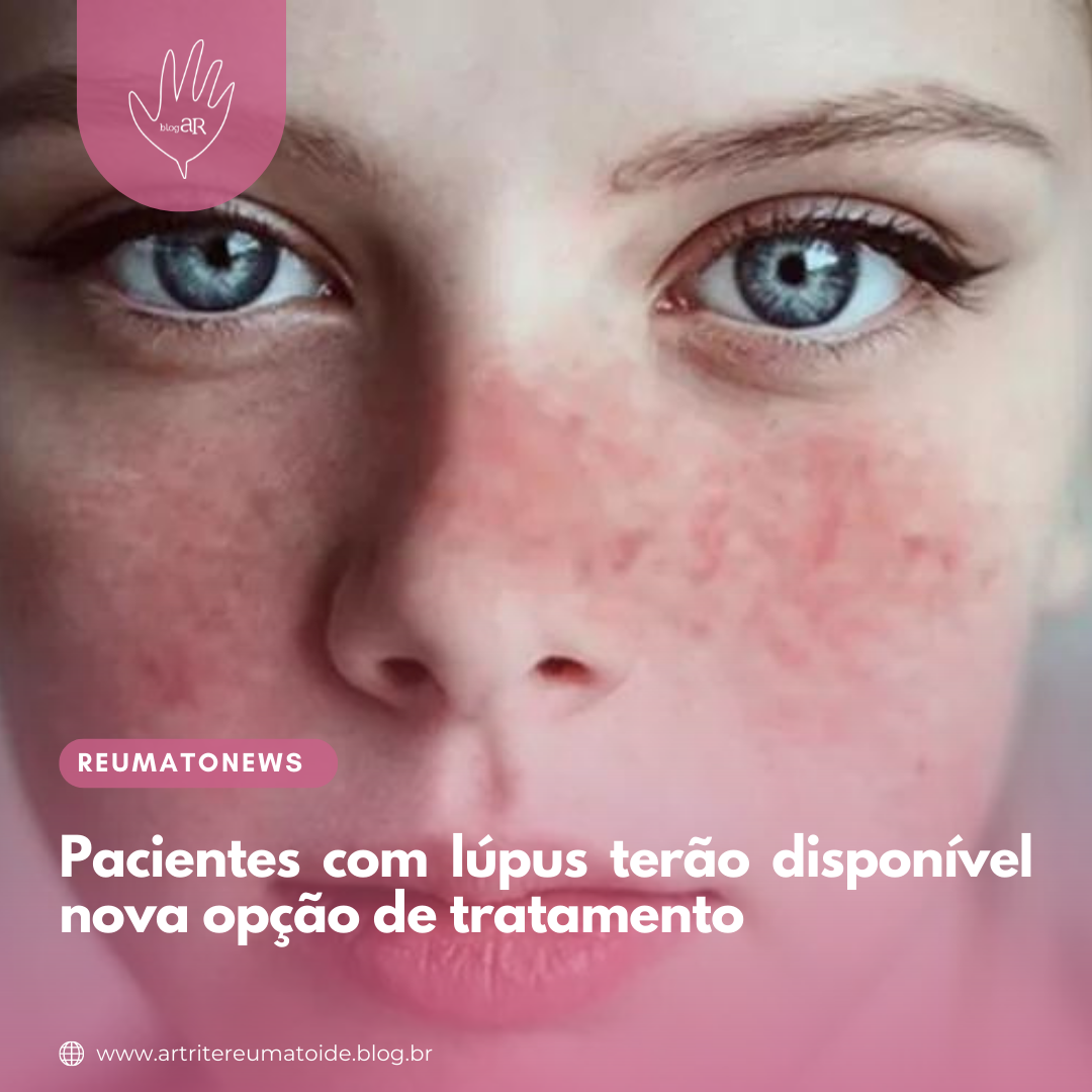 Pacientes com lúpus terão disponível nova opção de tratamento - Artrite