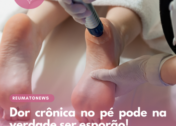 Dor crônica no pé pode na verdade ser esporão!