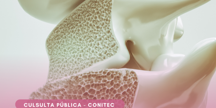 Ministério da Saúde abre consulta pública para atualização do protocolo de tratamento da Osteoporose no SUS