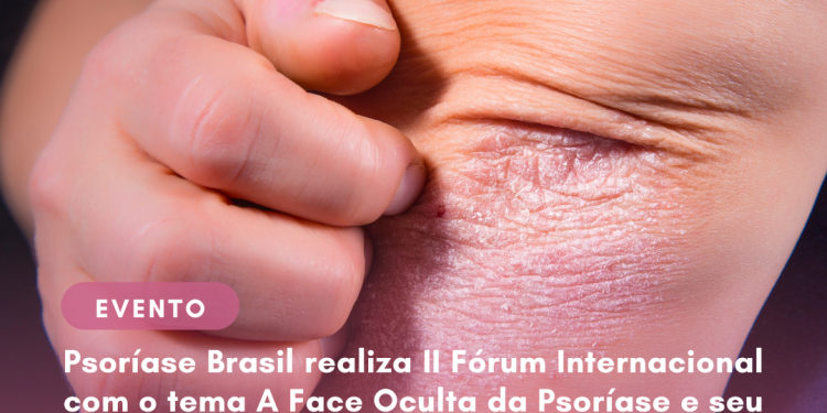 Psoríase Brasil realiza II Fórum Internacional com o tema A Face Oculta da Psoríase e seu Impacto no Bem-Estar