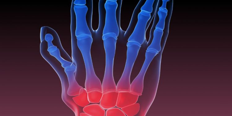 Importância do SUS para os pacientes com artrite reumatoide