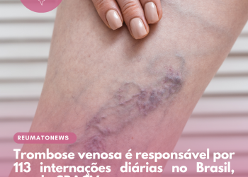 Trombose venosa é responsável por 113 internações diárias no Brasil, revela SBACV