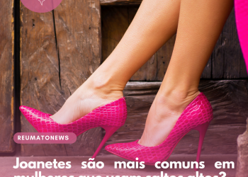 Joanetes são mais comuns em mulheres que usam saltos altos?