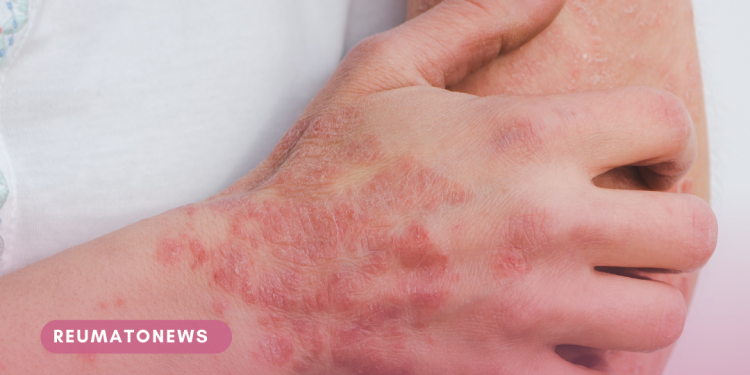 Psoríase pode estar ligada a diversas comorbidades e se manifesta de maneira moderada a grave em cerca de 20% dos pacientes