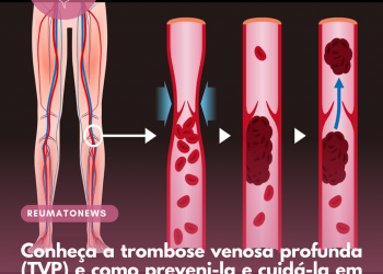 Conheça a trombose venosa profunda (TVP) e como preveni-la e cuidá-la em pacientes com câncer