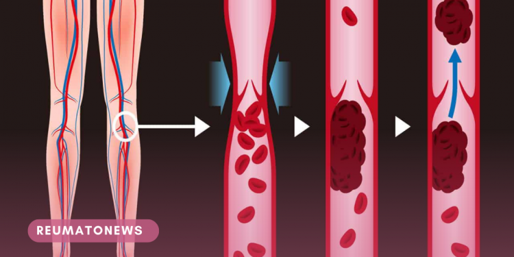 Conheça a trombose venosa profunda (TVP) e como preveni-la e cuidá-la em pacientes com câncer