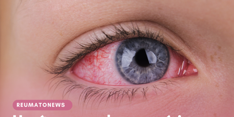 Uveíte: uma doença séria que é confundida com conjuntivite