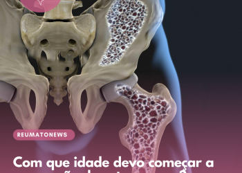 Com que idade devo começar a prevenção da osteoporose?