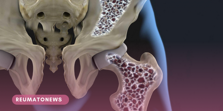 Com que idade devo começar a prevenção da osteoporose?