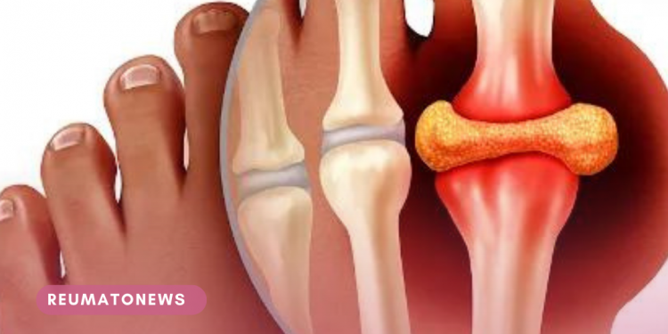 Gota: homens costumam ser os mais afetados