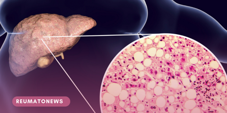Gordura no fígado: uma doença silenciosa que atinge 25% da população mundial