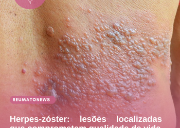 Herpes-zóster: lesões localizadas que comprometem qualidade de vida