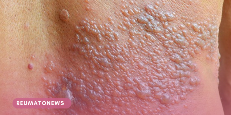 Herpes-zóster: lesões localizadas que comprometem qualidade de vida