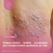Herpes-zóster: lesões localizadas que comprometem qualidade de vida