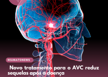Novo tratamento para o AVC reduz sequelas após a doença