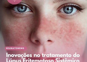 Inovações no tratamento do Lúpus Eritematoso Sistêmico