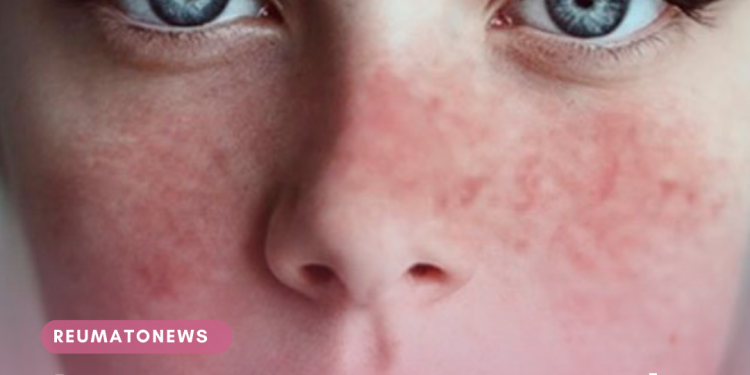 Inovações no tratamento do Lúpus Eritematoso Sistêmico