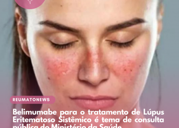 Belimumabe para o tratamento de Lúpus Eritematoso Sistêmico é tema de consulta pública do Ministério da Saúde