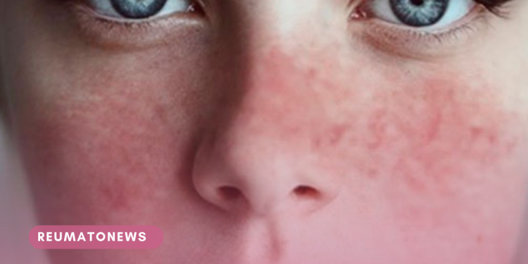 Mulheres respondem por 90% dos casos de lúpus, dizem especialistas