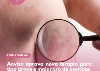 Anvisa aprova nova terapia para tipo grave e mais raro de psoríase