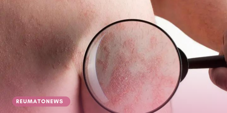 Anvisa aprova nova terapia para tipo grave e mais raro de psoríase