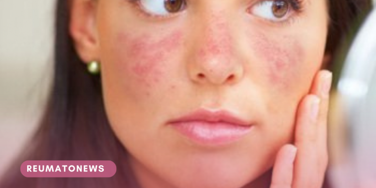 No dia Mundial do Lúpus, plenário do CNS traz para debate a atenção no SUS com o tratamento da doença