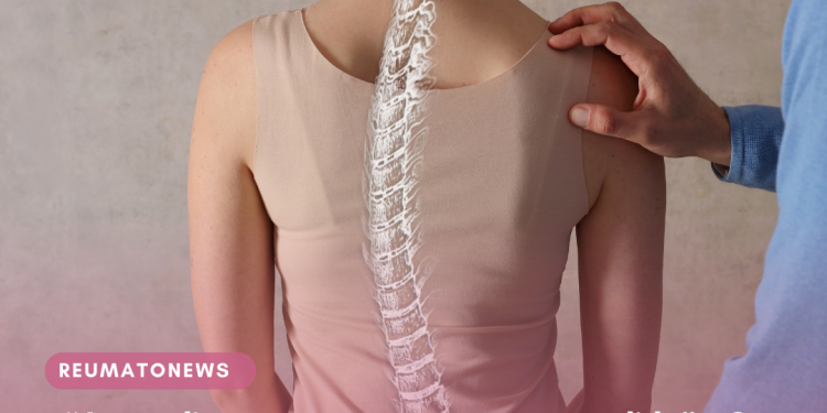 “A escoliose não merece ser escondida”. Os sinais da doença que afeta sobretudo raparigas e aos quais deve estar atento este verão