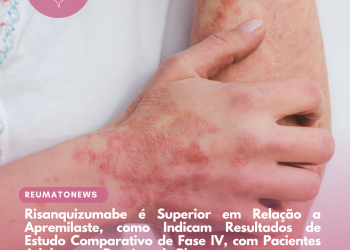 Risanquizumabe é Superior em Relação a Apremilaste, como Indicam Resultados de Estudo Comparativo de Fase IV, com Pacientes Adultos com Psoríase de Placas