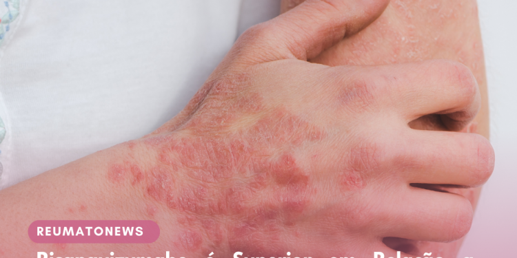 Risanquizumabe é Superior em Relação a Apremilaste, como Indicam Resultados de Estudo Comparativo de Fase IV, com Pacientes Adultos com Psoríase de Placas