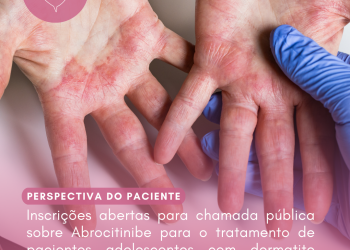 Dermatite Atópica: Abrocitinibe/Perspectiva do Paciente – Conitec