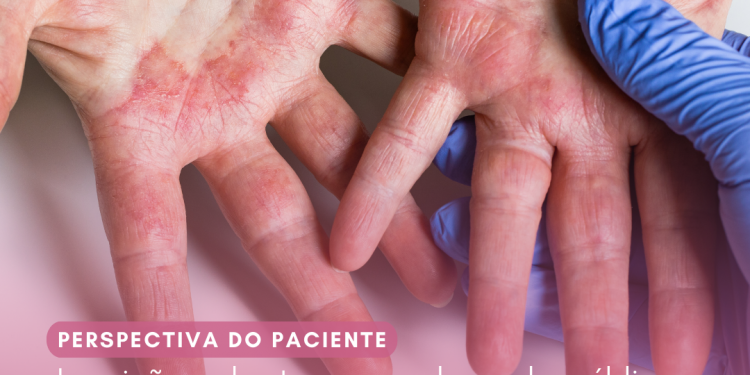 Dermatite Atópica: Abrocitinibe/Perspectiva do Paciente – Conitec