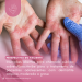 Dermatite Atópica: Abrocitinibe/Perspectiva do Paciente – Conitec