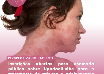 Dermatite Atópica: Upadacitinibe/Perspectiva do Paciente – Conitec