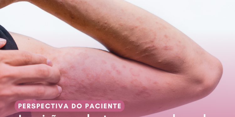Dermatite Atópica: Abrocitinibe/Perspectiva do Paciente – Conitec