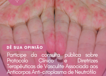 Protocolo Clínico e Diretrizes Terapêuticas: Vasculite Associada aos Anticorpos Anti-citoplasma de Neutrófilo/Consulta Pública – CONITEC