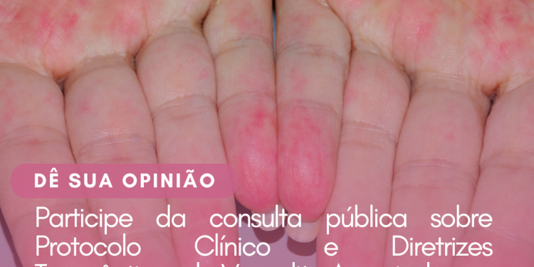 Protocolo Clínico e Diretrizes Terapêuticas: Vasculite Associada aos Anticorpos Anti-citoplasma de Neutrófilo/Consulta Pública – CONITEC