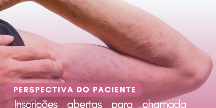 Dermatite atópica: Furoato de mometasona 0,1%/Perspectiva do Paciente – CONITEC