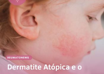 Dermatite Atópica e o tratamento no SUS