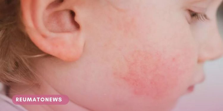 Dermatite Atópica e o tratamento no SUS