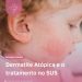 Dermatite Atópica e o tratamento no SUS