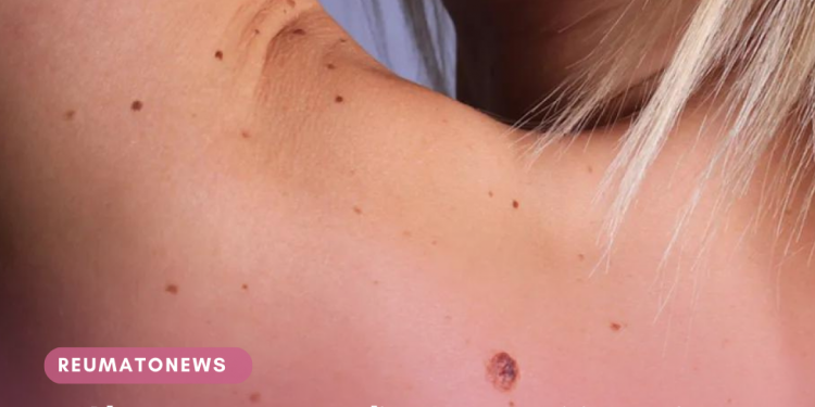 Alerta para procedimentos estéticos: pinta preta não deve ser tratada por profissionais não médicos