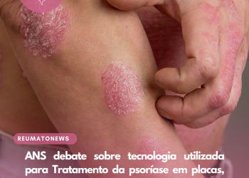 ANS debate sobre tecnologia utilizada para Tratamento da psoríase em placas, moderada a grave
