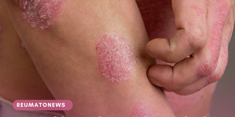 ANS debate sobre tecnologia utilizada para Tratamento da psoríase em placas, moderada a grave