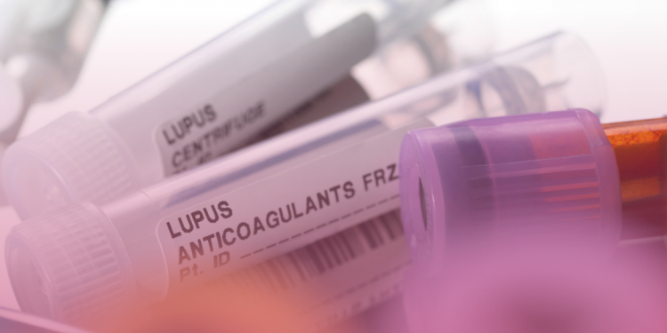 Lúpus: a importância da pesquisa clínica na busca de novos tratamentos para a doença