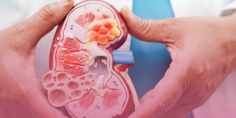 ANS debate sobre tratamento de pacientes adultos com nefrite lúpica ativa