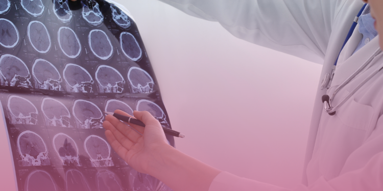 Esclerose Múltipla: mitos e verdades sobre a doença que atinge mais de 40 mil brasileiros